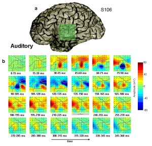 Example of intracranial ERP responses to an auditory speech stimulus recorded on a 8×8 macro-electrode grid