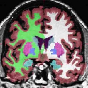 Figure 2: Automated segmentation of subcortical brain structures