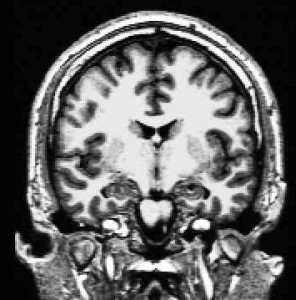 Figure 1: Structural T1-weighted Magnetic Resonance Image, optimized for grey/white matter contrast
