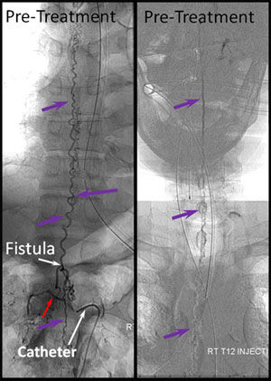 Spinal Dural Arteriovenous Fistula (SDAVF) | Radiology venous diagram 